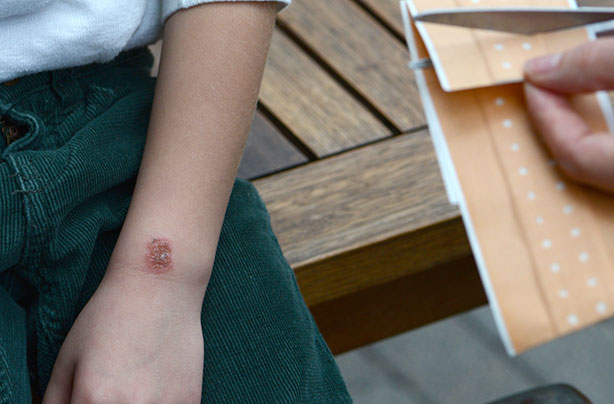 Child burn