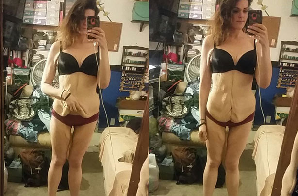 Amber Forill excess skin removal crowdfunding