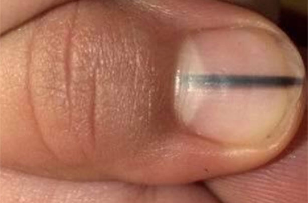 Skin cancer nail melanoma warning