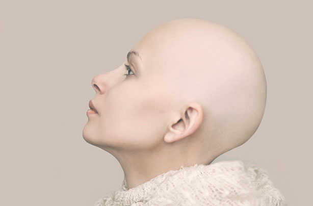 Alopecia